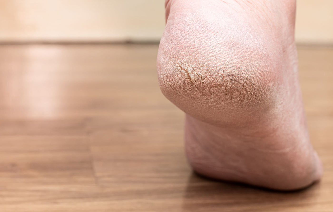 Mes pieds sont fissurés, aidez-moi!